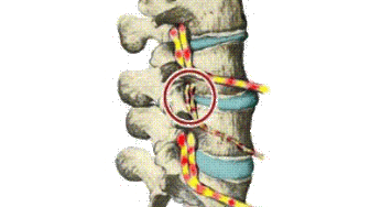 Subluxation Explained